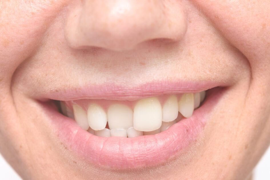 Reasons for Crooked Teeth - How to Straighten Them