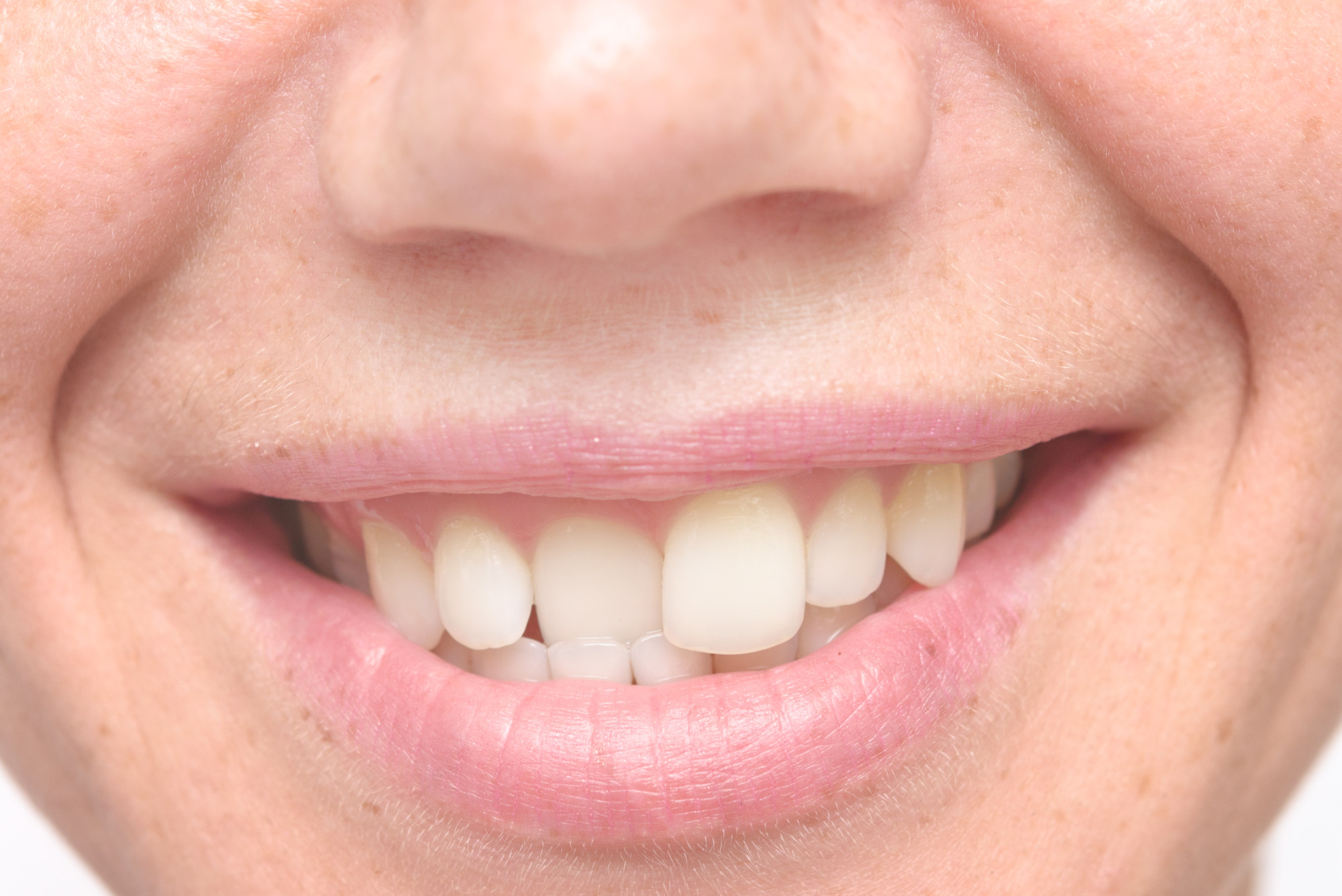 Reasons for Crooked Teeth - How to Straighten Them